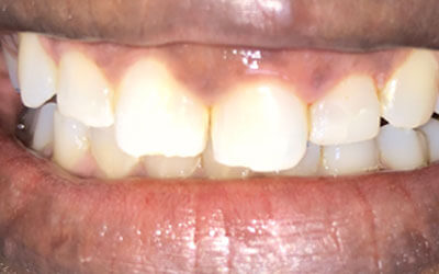 After chipped tooth 1
