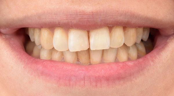 teeth whitening before