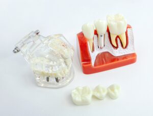 Dental bridge and dental implant models showing options for replacing missing teeth